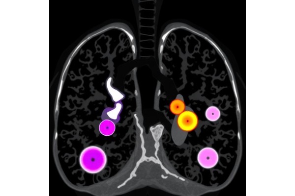 How Respiratory Phase Influences 3D Quantitative Analysis of Pulmonary Subsolid Nodules in Low-Dose CT Lung Cancer Screening