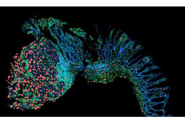 How Chronic Inflammation Can Be Stopped from Developing into Cancer