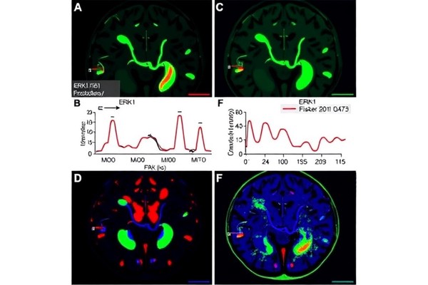 ERK1 Phosphorylation Boosts Fructolysis in Glioblastoma