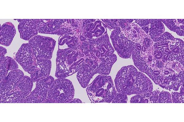 Childhood Kidney Cancer Exhibits Millions of Genetic Mutations, Paving the Way for New Treatment Opportunities