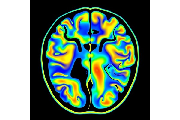 Deep Learning Predicts Parkinson’s Dyskinesia from PET