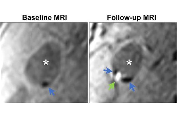 Carotid Plaque: A Growing Threat to Vascular Health Over Time