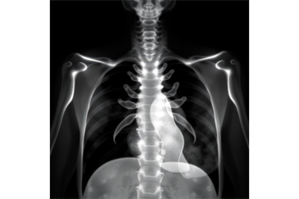 Rethinking Male Risk in Bronchopulmonary Dysplasia