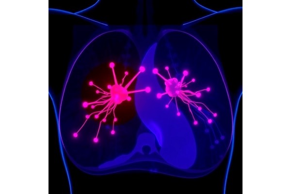 Dual-Laser Approach Transforms Breast Cancer Photothermal Therapy