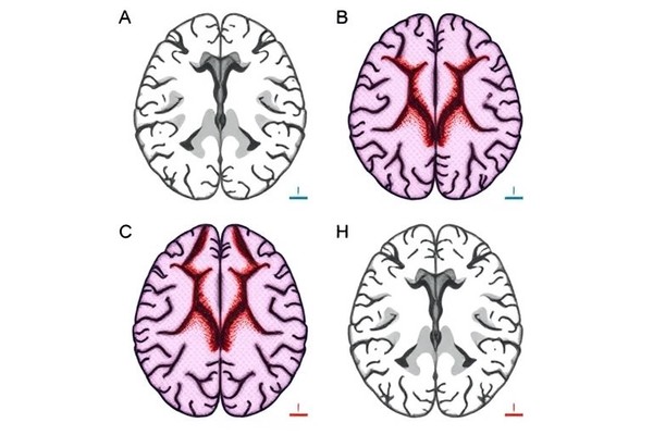 Cortical Microstructure Abnormalities Link Lewy Bodies, Alzheimer’s