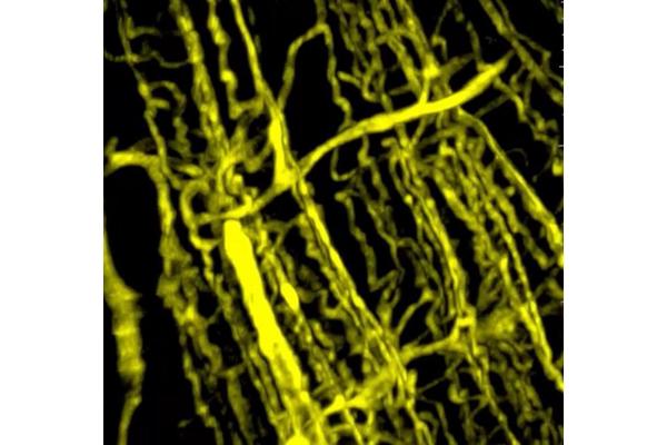 Impaired Blood Vessel Function Drives Muscle Wasting in Cancer
