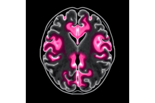 Punctate White Matter Lesions Predict Cerebral Palsy