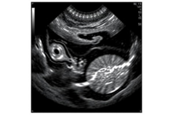 High-Frequency Ultrasound Differentiates Lymph Nodes