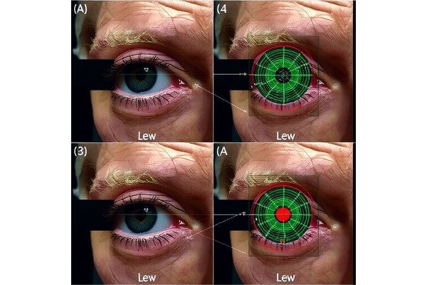 Automated Eyelid Movement Analysis in Early Parkinson’s